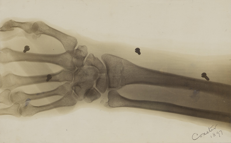 Lot 4122, Auction  127, X-Ray Photography, X-ray of a forearm and hand